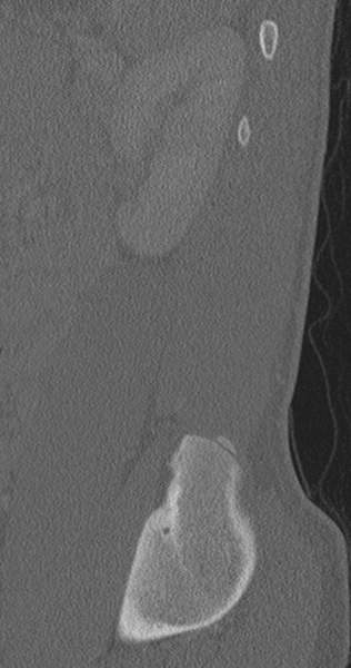 File:Chance fracture (Radiopaedia 40360-42912 Sagittal bone window 15).png
