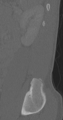 Chance fracture (Radiopaedia 40360-42912 Sagittal bone window 15).png
