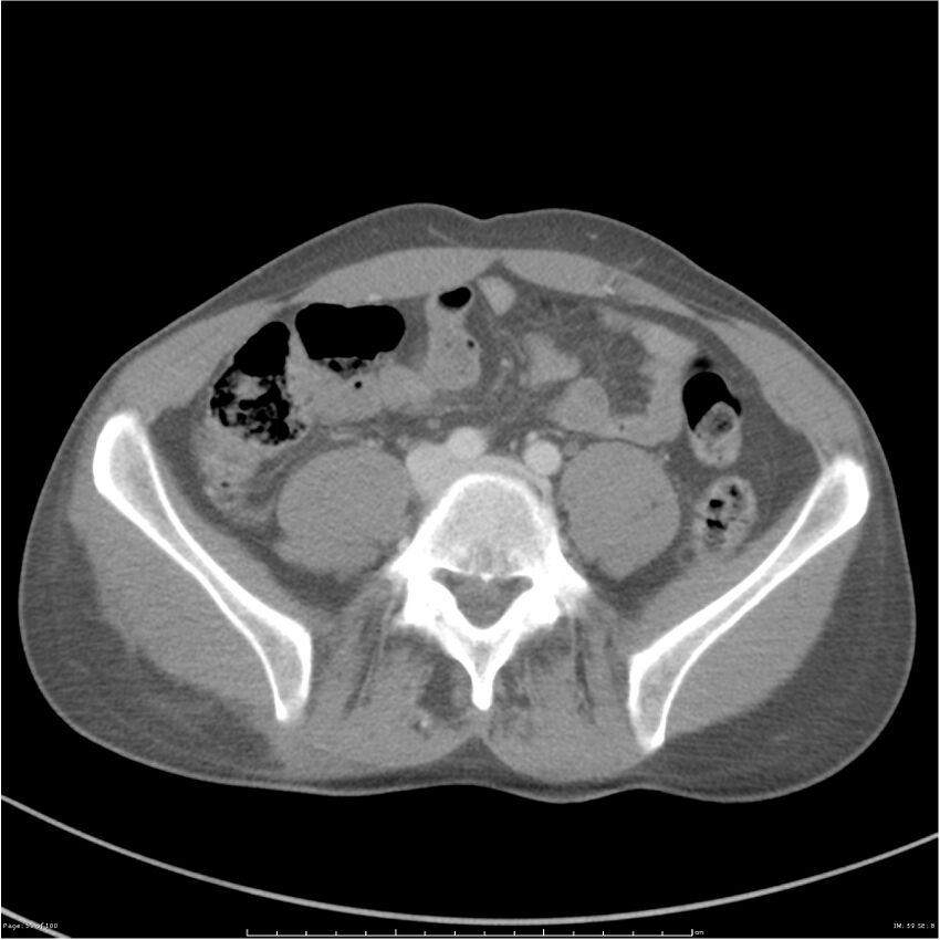 Chest and abdomen multi-trauma (Radiopaedia 26294-26426 A 59).jpg