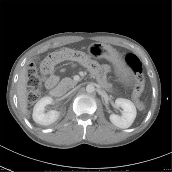 File:Chest and abdomen multi-trauma (Radiopaedia 26294-26426 bone window 33).jpg
