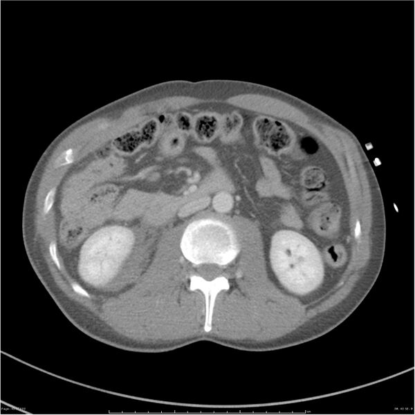 File:Chest and abdomen multi-trauma (Radiopaedia 26294-26426 bone window 40).jpg