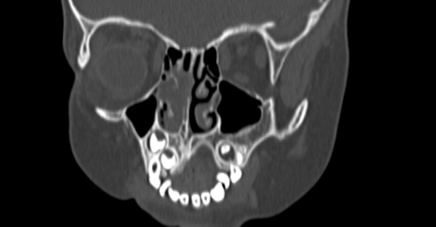 Choanal atresia (Radiopaedia 51295-56972 Coronal bone window 29).jpg