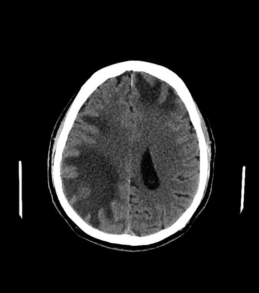 File:Cholangiocarcinoma with cerebral metastases (Radiopaedia 83519-98628 Axial non-contrast 44).jpg