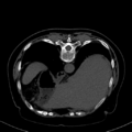 Cholecystitis - CT IVC obstructive choledocholitiasis (Radiopaedia 43966-47479 Axial Biliscopin 21).png