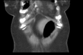 Cholecystitis - CT IVC obstructive choledocholitiasis (Radiopaedia 43966-47479 Coronal Biliscopin 9).png