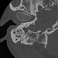 Cholesteatoma (Radiopaedia 15846-15494 bone window 28).jpg