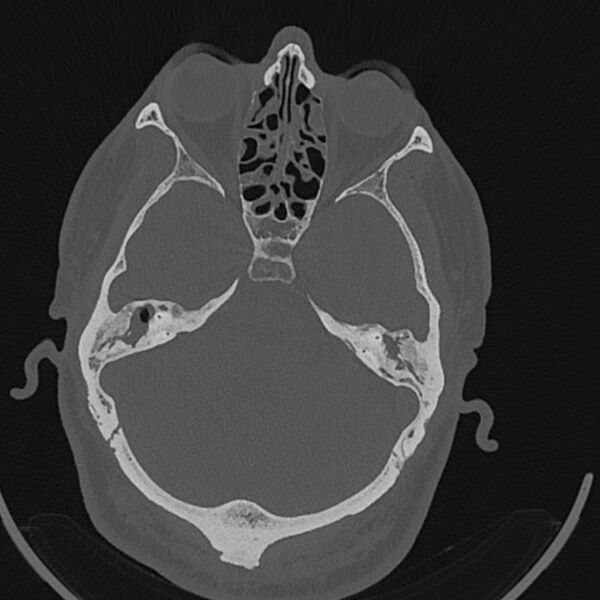 File:Cholesteatoma (Radiopaedia 68176-77673 Axial bone window 59).jpg