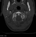 Chondroblastoma - occipital condyle (Radiopaedia 5569-7304 bone window 11).jpg