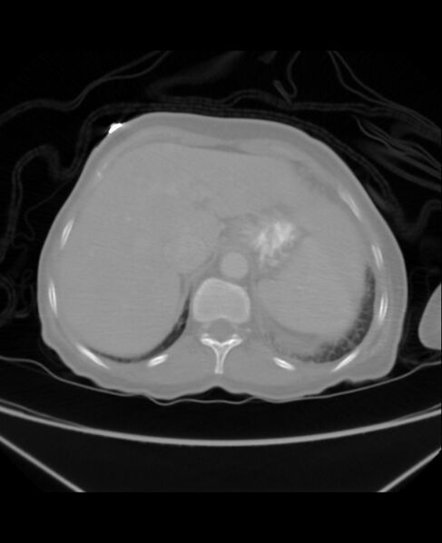 File:Chondrosarcoma (Radiopaedia 79427-92535 Axial lung window 49).jpg
