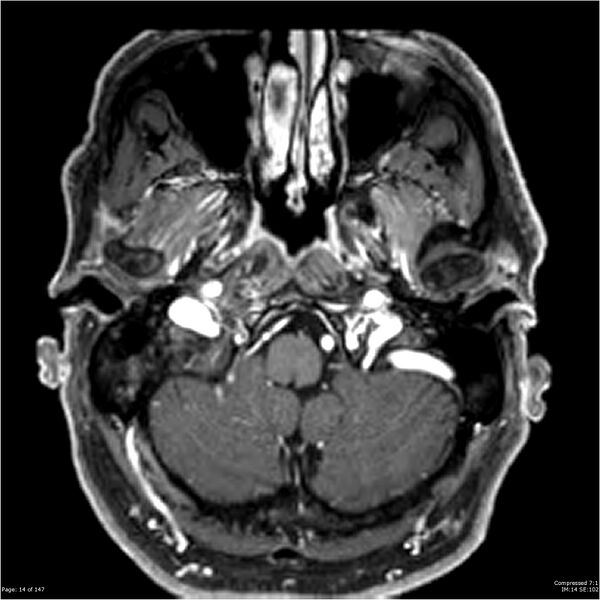 File:Chondrosarcoma of skull base- grade II (Radiopaedia 40948-43654 Axial T1 C+ 2).jpg
