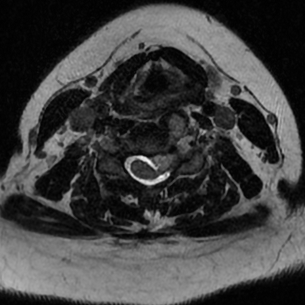 File:Chordoma - cervical spine (Radiopaedia 70084-80111 Axial T2 51).png