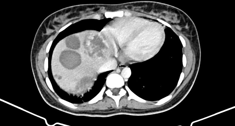 File:Choriocarcinoma liver metastases (Radiopaedia 74768-85766 A 22).jpg