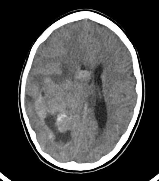 File:Choroid plexus carcinoma (Radiopaedia 91013-108552 Axial non-contrast 36).jpg