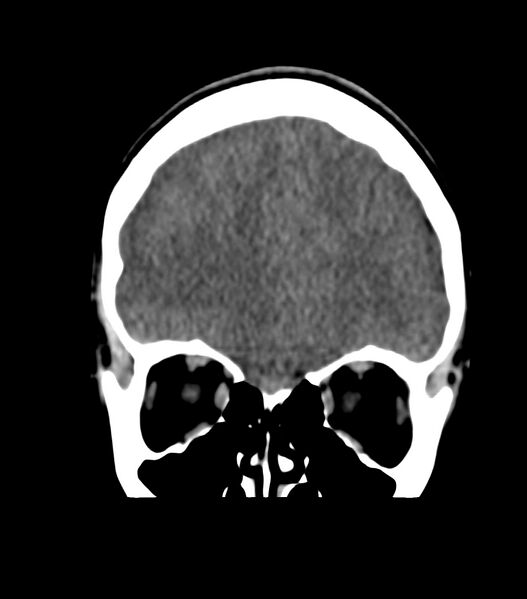 File:Choroid plexus carcinoma (Radiopaedia 91013-108552 Coronal non-contrast 20).jpg