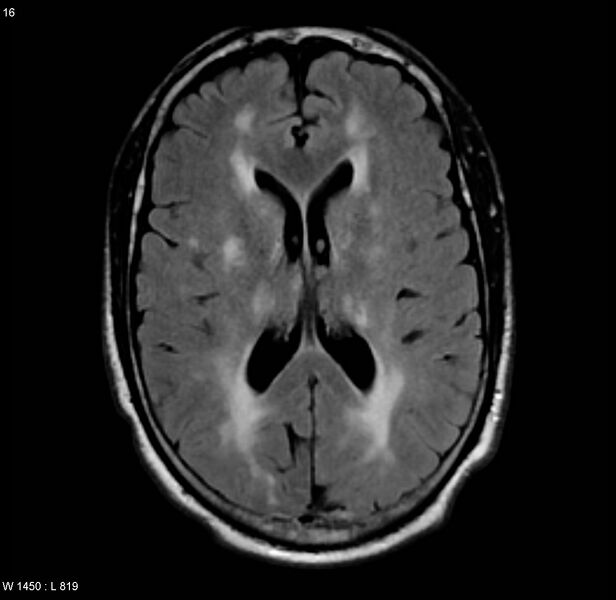 File:Chronic hypertensive encephalopathy (Radiopaedia 4564-6686 Axial FLAIR 9).jpg