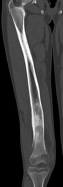 File:Chronic ostemyelitis of the femur with long sinus tract (Radiopaedia 74947-85982 Coronal bone window 41).jpg