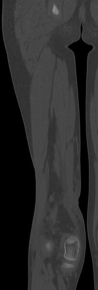 File:Chronic ostemyelitis of the femur with long sinus tract (Radiopaedia 74947-85982 Coronal bone window 60).jpg