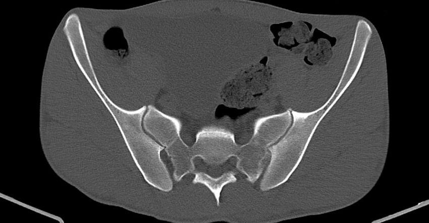 Chronic osteomyelitis (with sequestrum) (Radiopaedia 74813-85822 Axial non-contrast 10).jpg