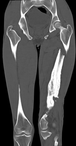 File:Chronic osteomyelitis (with sequestrum) (Radiopaedia 74813-85822 Coronal non-contrast 33).jpg