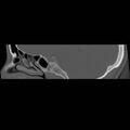 Chronic otomastoiditis (Radiopaedia 27138-27309 Sagittal bone window 27).jpg