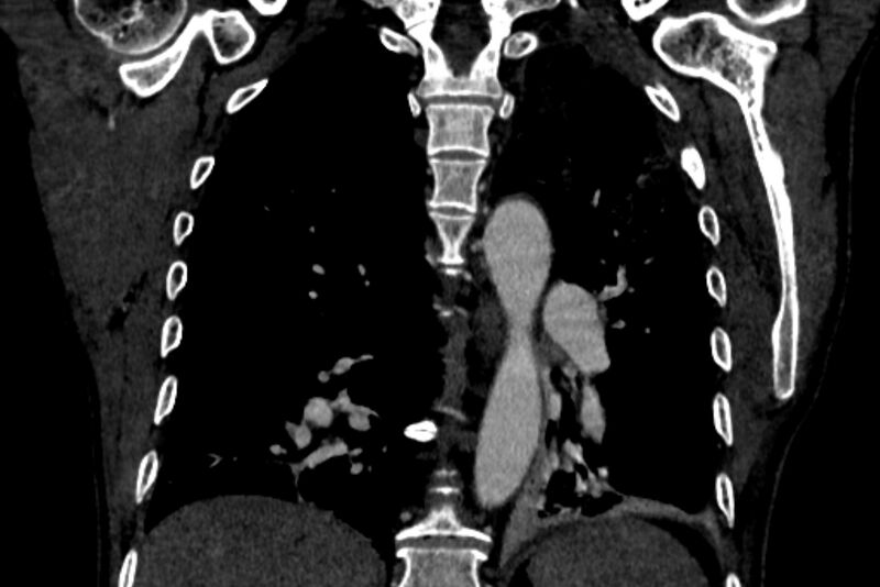 File:Chronic pulmonary embolism with bubbly consolidation (Radiopaedia 91248-108850 B 97).jpg