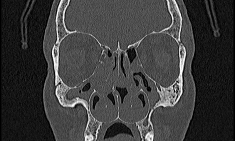 File:Chronic rhinosinusitis (Radiopaedia 65079-74075 Coronal bone window 31).jpg