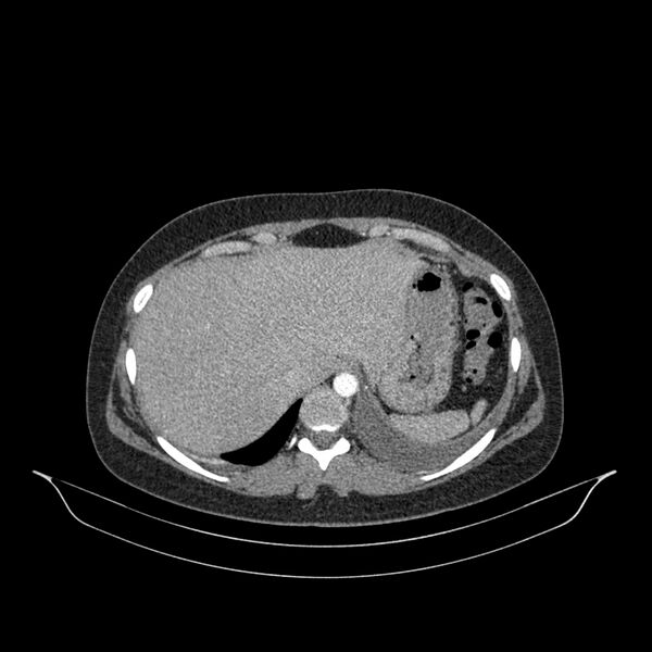 File:Chronic thromboembolic pulmonary hypertension (CTEPH) (Radiopaedia 74597-85532 Axial C+ CTPA 20).jpg