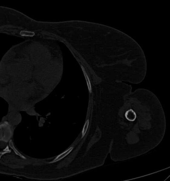 File:Clear cell chondrosarcoma - humerus (Radiopaedia 63104-71612 Axial bone window 95).jpg