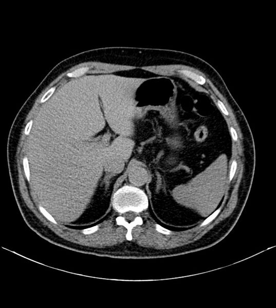 File:Clear cell renal cell carcinoma (Radiopaedia 85006-100539 H 2).jpg
