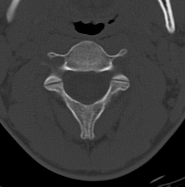 File:Cleft of the posterior arch of C1 mimicking fracture (Radiopaedia 40201-42721 Axial bone window 5).jpg