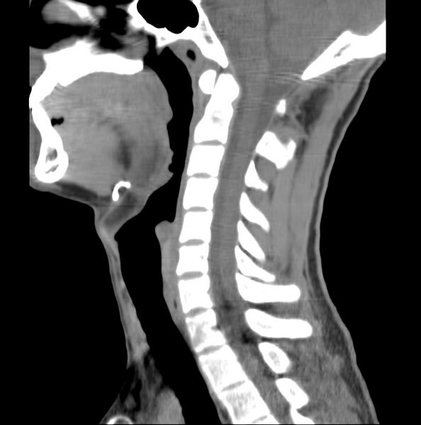 File:Cleft of the posterior arch of C1 mimicking fracture (Radiopaedia 40201-42721 E 1).jpg