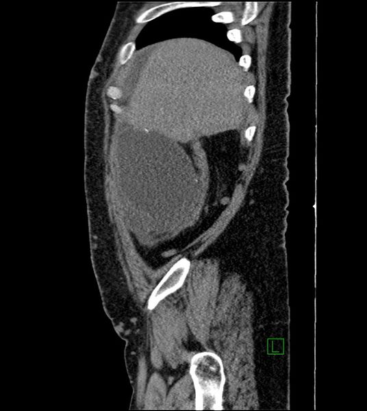 File:Closed-loop small bowel obstruction-internal hernia (Radiopaedia 78439-91096 C 121).jpg