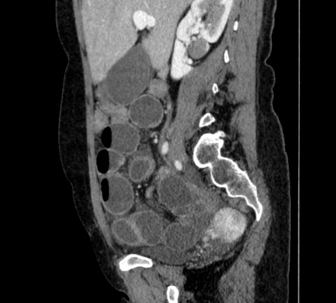 File:Closed loop small bowel obstruction (Radiopaedia 71211-81508 C 48).jpg