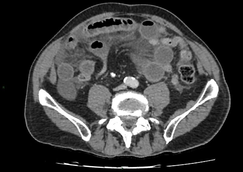 File:Closed loop small bowel obstruction with ischemia (Radiopaedia 84180-99456 A 75).jpg
