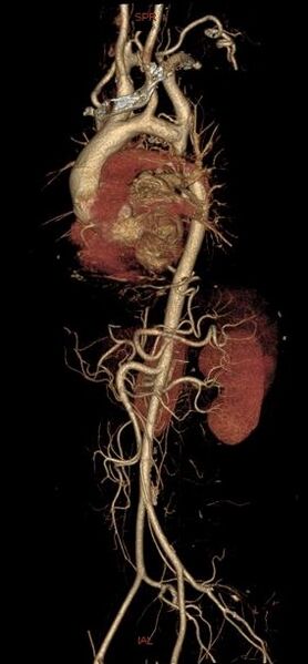 File:Coarctation of aorta (Radiopaedia 25384-25630 D 1).jpg