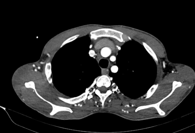 File:Coarctation of aorta with aortic valve stenosis (Radiopaedia 70463-80574 A 18).jpg