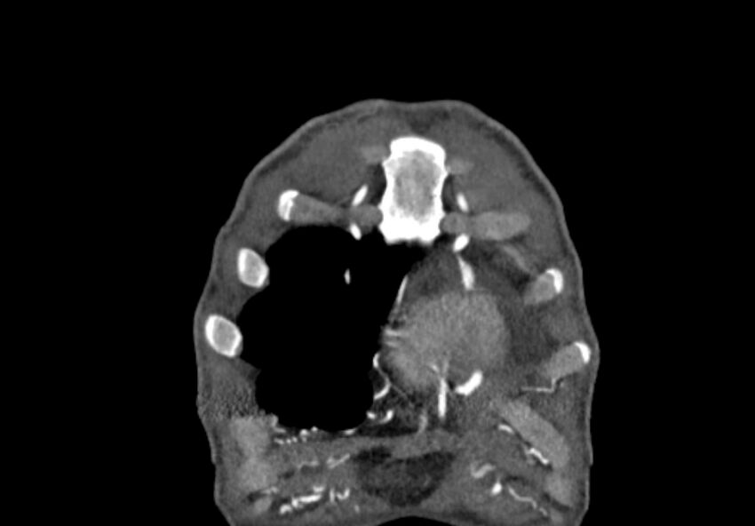 Coarctation of aorta with aortic valve stenosis (Radiopaedia 70463-80574 C 1).jpg