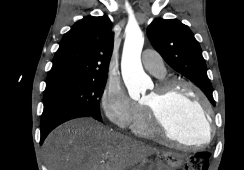 File:Coarctation of aorta with aortic valve stenosis (Radiopaedia 70463-80574 C 76).jpg
