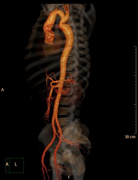 File:Coarctation of the aorta (Radiopaedia 49784-55050 3D VRT 18).jpg