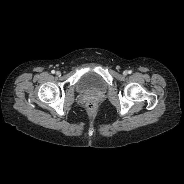 File:Cocoon abdomen with possible tubo-ovarian abscess (Radiopaedia 46235-50636 A 43).png