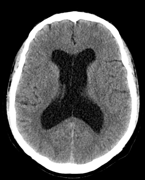 File:Colloid cyst of the third ventricle (Radiopaedia 86571-102661 Axial non-contrast 19).png