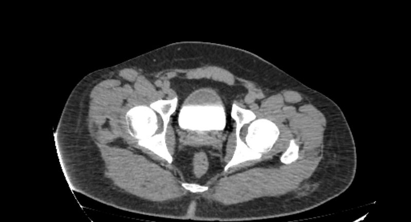 File:Colocutaneous fistula (Radiopaedia 56401-63062 Axial Fistulography 56).jpg