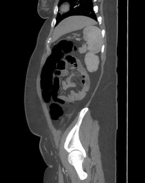 File:Colonic pseudo-obstruction (Radiopaedia 79752-92980 C 60).png