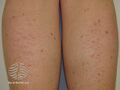 Eczema craquelé (DermNet NZ dermatitis-eczema-craquele3).jpg