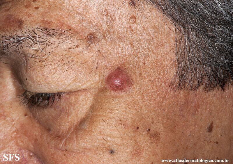 File:Melanoma (Dermatology Atlas 106).jpg