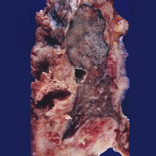 File:Mesothelioma (gross pathology) (Radiopaedia 8699).jpg