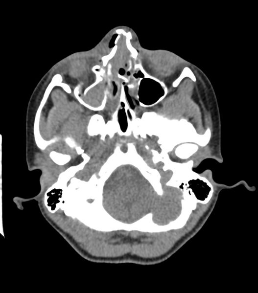 File:Nasoorbitoethmoid fracture (Radiopaedia 90044-107205 Axial non-contrast 141).jpg