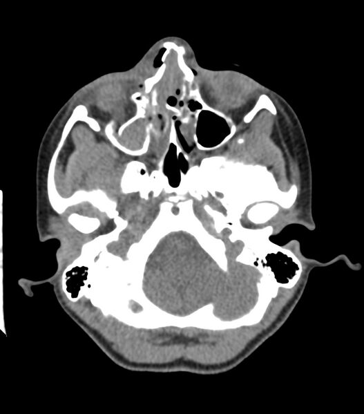 File:Nasoorbitoethmoid fracture (Radiopaedia 90044-107205 Axial non-contrast 142).jpg