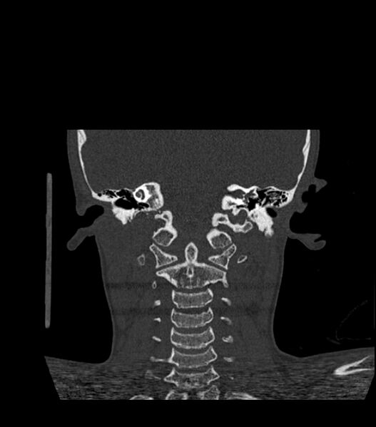 File:Nasoorbitoethmoid fracture (Radiopaedia 90044-107205 Coronal bone window 104).jpg