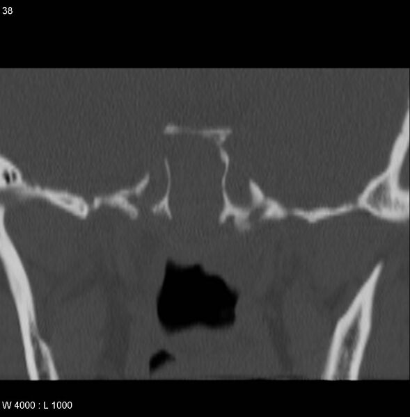 File:Nasopharyngeal carcinoma (recurrent) (Radiopaedia 5061-6903 Coronal bone window 12).jpg